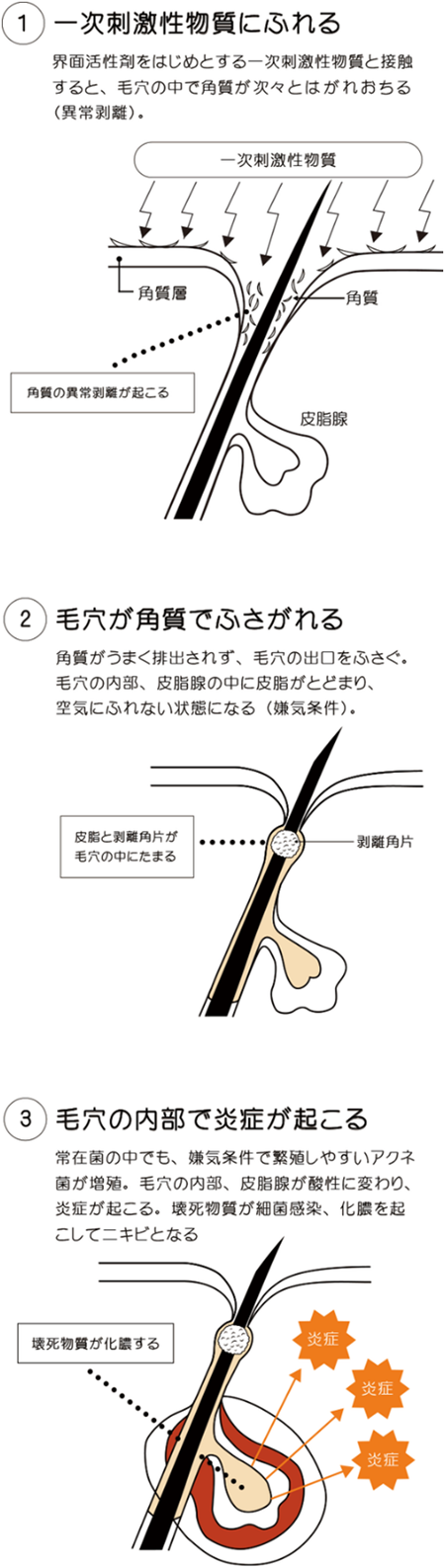 にきびができるしくみ